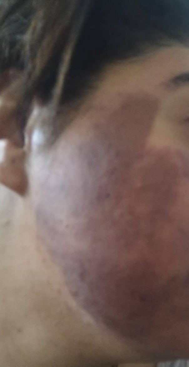 «وجهي اتغير بعد جلسة تجميل».. مواطنة تستغيث وتتهم طبيبة بالتسبب في تصبغات حادة